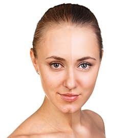 chemical-peels