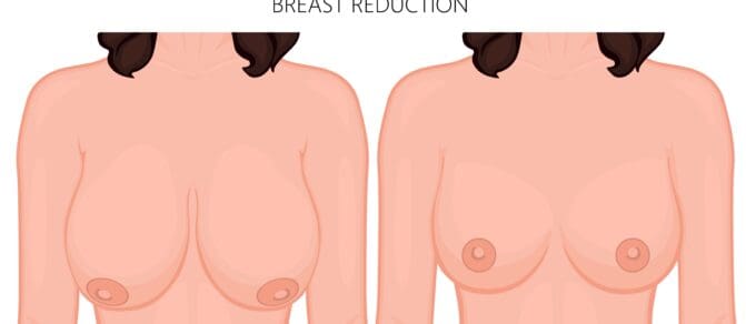 Breast Lift with Implants or Fat Transfer in Wirral